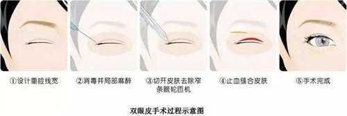 埋線雙眼皮