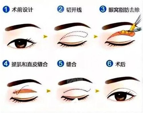 埋線雙眼皮