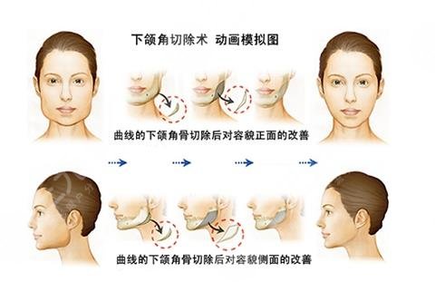 磨下頜角手術(shù)經(jīng)歷