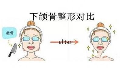 磨下頜角手術(shù)經(jīng)歷