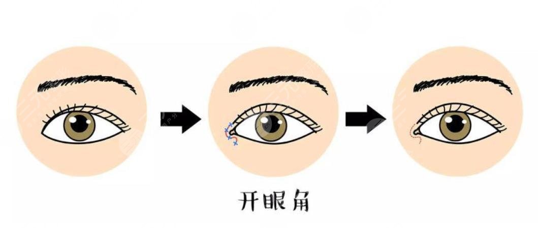 開眼角手術(shù)和不開眼角的區(qū)別