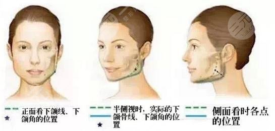 李志海顴骨內(nèi)推案例對比圖