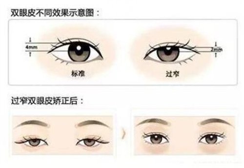張誠(chéng)教授做眼修復(fù)案例,7天get自然靈動(dòng)大雙眼