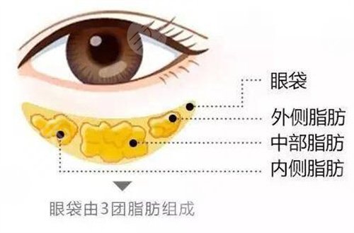 微創(chuàng)去眼袋一般適合什么年齡？任何年齡都可以做這項目嗎？