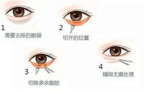 微創(chuàng)去眼袋一般適合什么年齡？任何年齡都可以做這項目嗎？