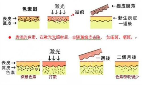激光祛黃褐斑反多久可以恢復(fù)
