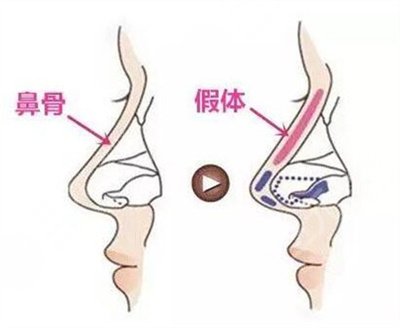 鷹鉤鼻矯正術(shù)后注意事項