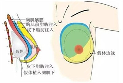 c罩杯多大胸圖片欣賞丨胸部整形手術(shù)之后需要注意什么？