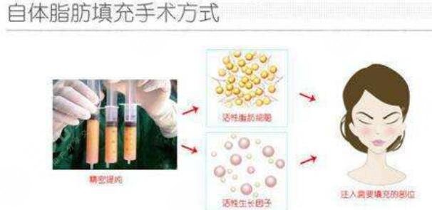 北京協(xié)和醫(yī)院整形科自體脂肪填充面頰項(xiàng)目案例體驗(yàn)反饋：