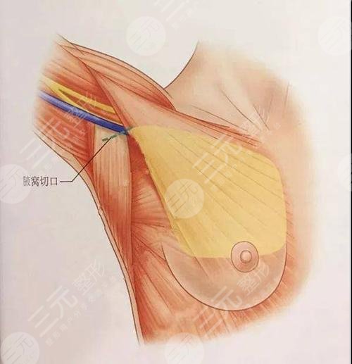 廣州南方醫(yī)院整形美容外科隆胸案例
