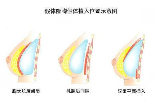 美國(guó)娜綺麗假體術(shù)后應(yīng)該如何進(jìn)行保養(yǎng)？