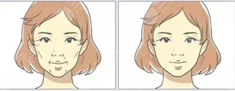 面部填充