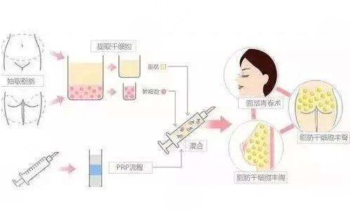 自體脂肪填充太陽凹陷能維持多久？多少錢？疼嗎？附價格表+注意事項