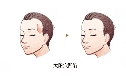 自體脂肪填充太陽凹陷能維持多久？多少錢？疼嗎？附價格表+注意事項