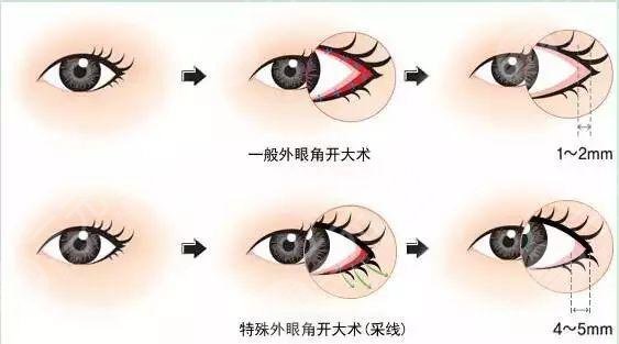 開(kāi)內(nèi)眼角手術(shù)果好嗎?