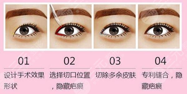 開(kāi)內(nèi)眼角手術(shù)后的注意事項(xiàng)