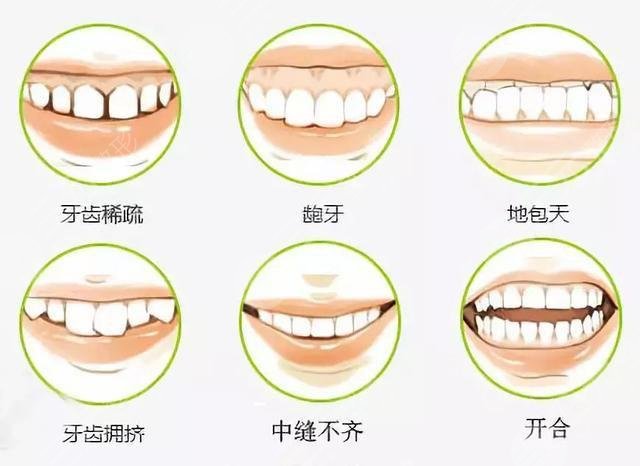 隱形矯正牙齒手術(shù)原理