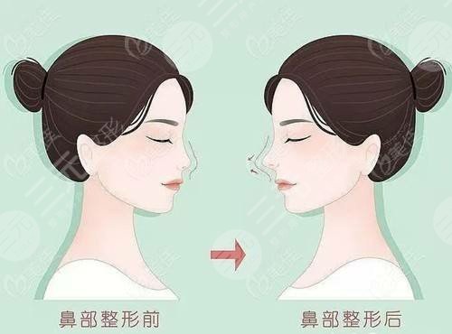 深圳依美醫(yī)療美容門診部小翹鼻照片