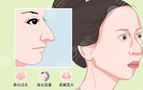 鷹鉤鼻矯正