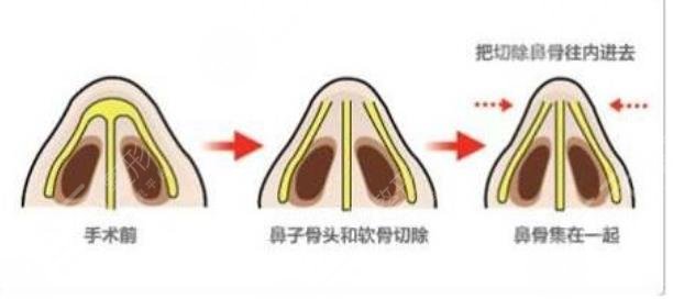 鷹鉤鼻矯正