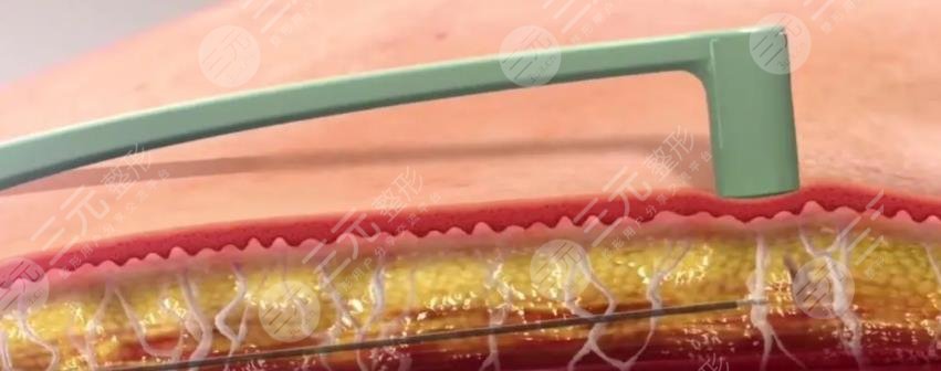 鉆石吸脂