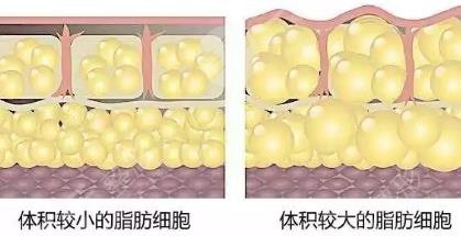 吸脂