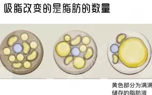 吸脂
