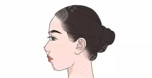 嘴凸矯正