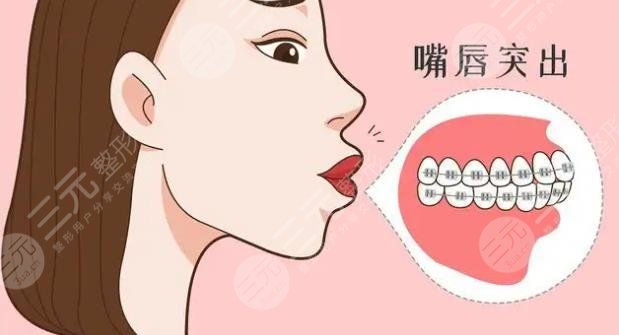嘴巴突出