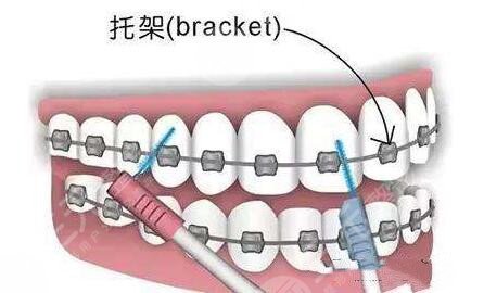 個性化舌側隱形矯