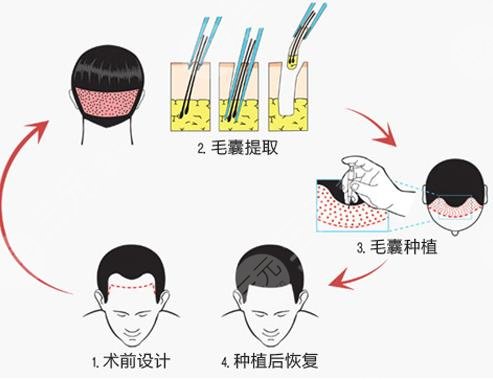 發(fā)際線(xiàn)種植手術(shù)項(xiàng)目案例