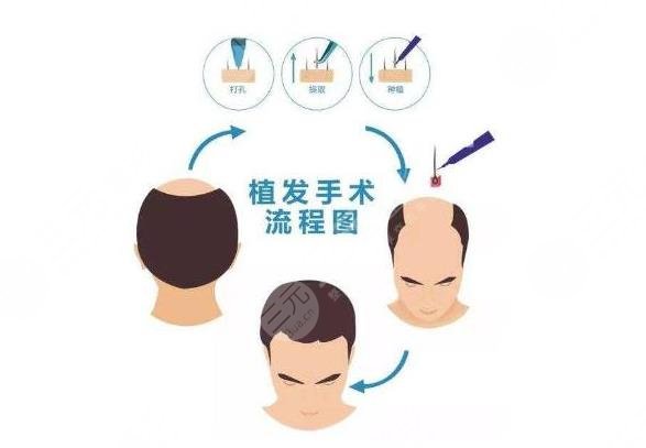 醫(yī)院植發(fā)手術(shù)項(xiàng)目相關(guān)科普