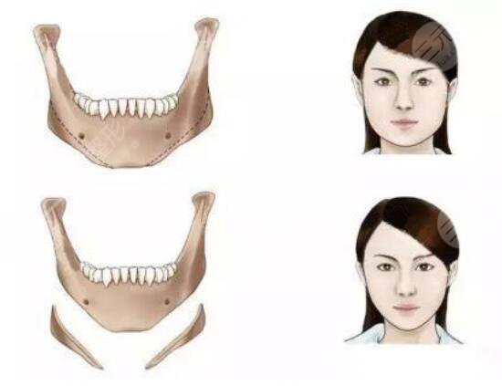 瓜子臉手術