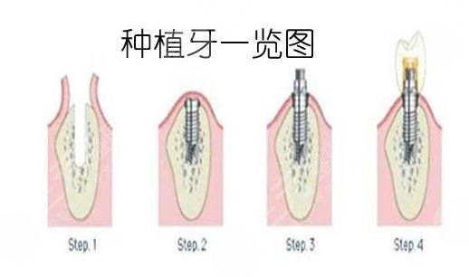 種植牙手術(shù)項目案例