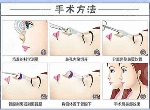 鼻翼缺損修復(fù)手術(shù)的難易程度，手術(shù)大致操作步驟