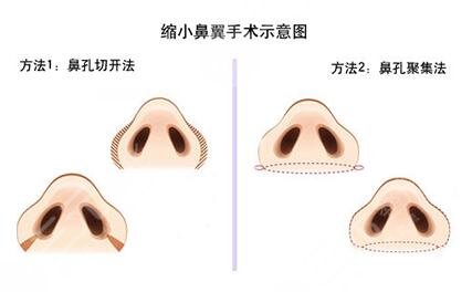 骨膜下隆鼻整形手術(shù)怎么做的？哪種情況適合做？