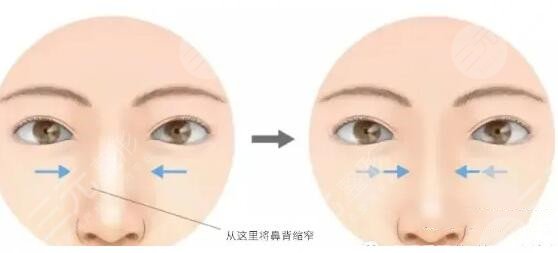 假體隆鼻術(shù)前
