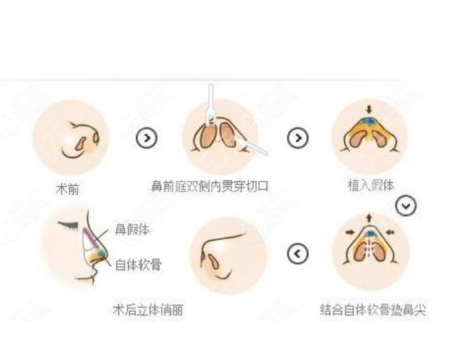 怎么使鼻子變小?一般需要多少錢?