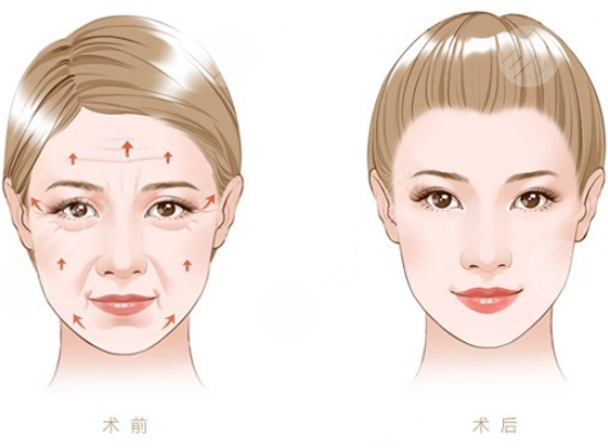 小拉皮手術(shù)后7天照片對比圖來了