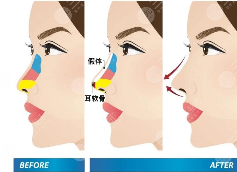武漢協(xié)和醫(yī)院整形科隆鼻案例
