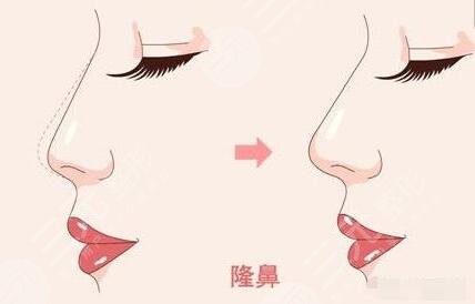 做隆鼻手術(shù)怎么避免失敗?