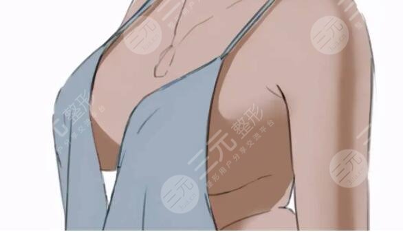 娜綺麗隆胸多少錢更合理？為什么有的姐妹花費(fèi)11萬巨款？是物超所值嗎？
