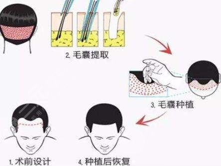 發(fā)際線種植