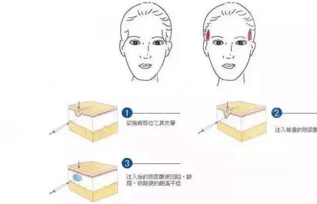 玻尿酸豐太陽穴