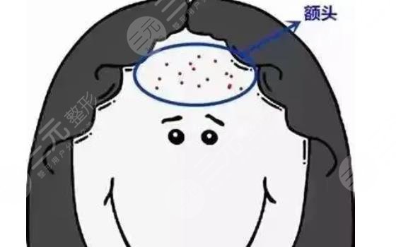 額頭長痘