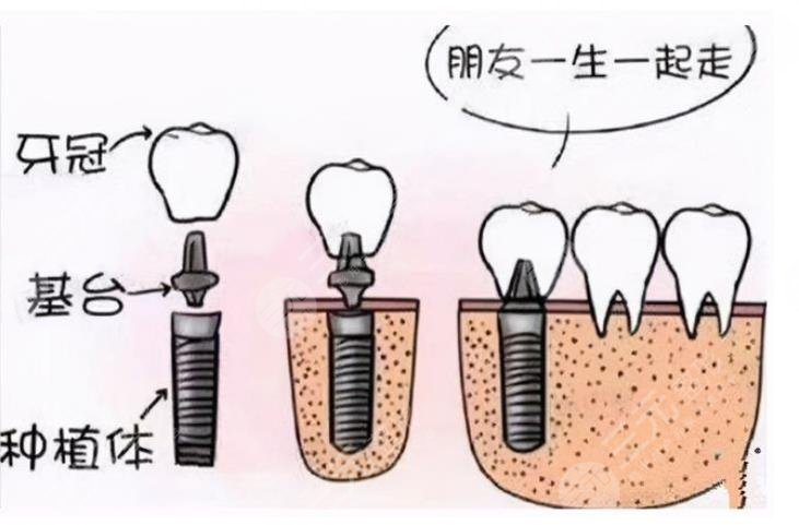 廣州穗華口腔門診部種植牙的案例介紹