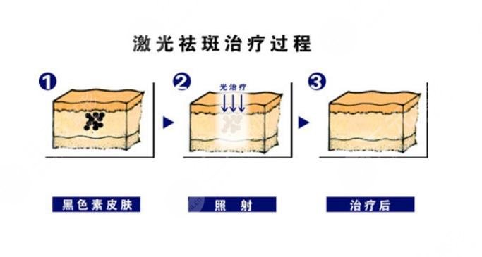 如何有祛斑不反彈?