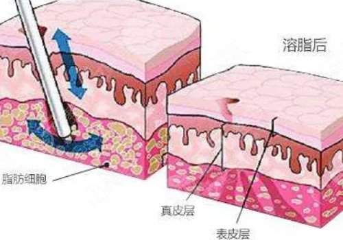 鐳射溶脂