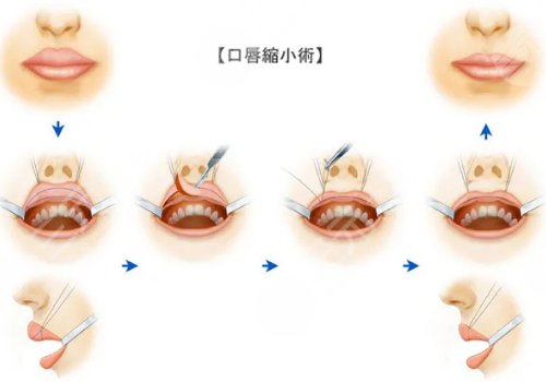 厚唇變薄手術(shù)多少錢？