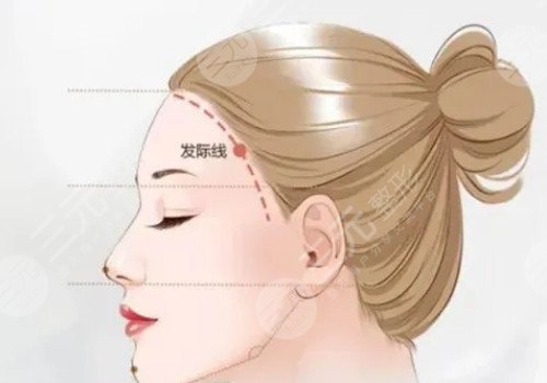 發(fā)際線移植能保持多久？